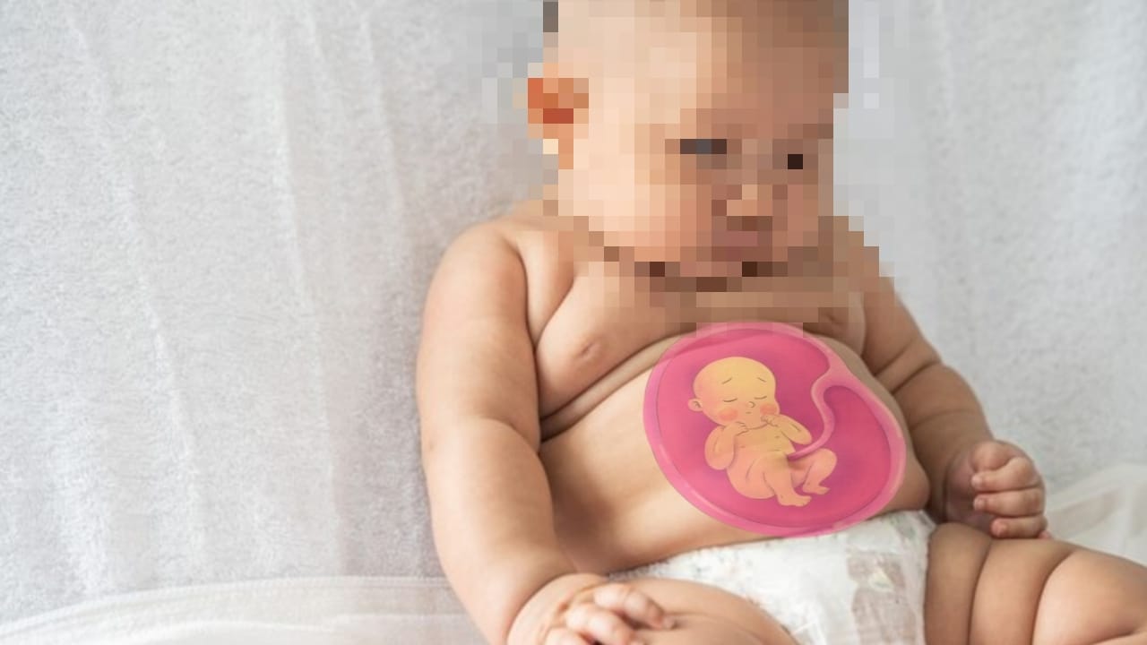 Bayi 5 Bulan Hamil, Dokter: Ada Janin Hidup di Perutnya