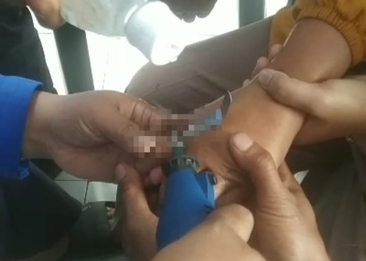 Pemotongan Cincin Nyangkut di Jari Berlangsung Dramatis