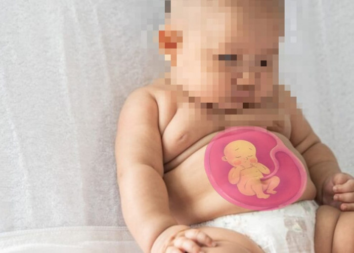 Bayi 5 Bulan Hamil, Dokter: Ada Janin Hidup di Perutnya